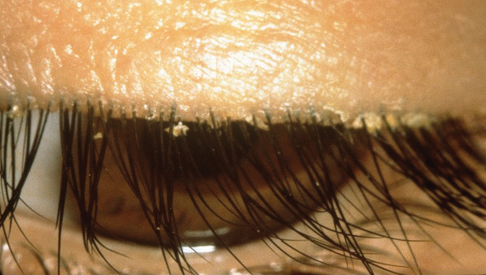 (D) Blepharitis on the top eye lid