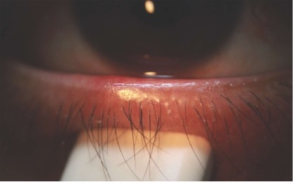Start HEALTHY ~ Identify and address lid or ocular surface disease