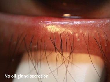 Blocked eyelid oil gland secretion
